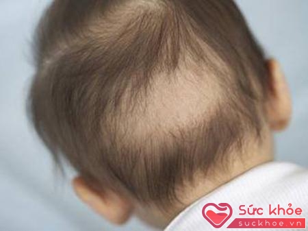 Rụng tóc vành khăn xảy ra ở trẻ nhỏ