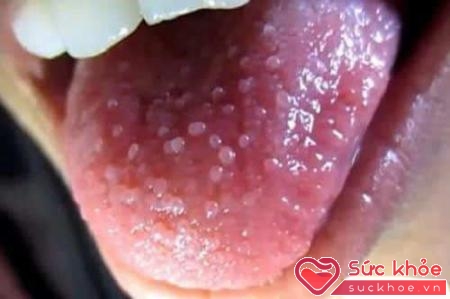 Đau khi nhai nuốt là triệu chứng sùi mào gà ở lưỡi giai đoạn đầu