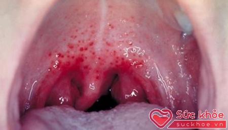 Sùi mào gà ở lưỡi nếu không điều trị dứt điểm sẽ dẫn tới ung thư vòm họng
