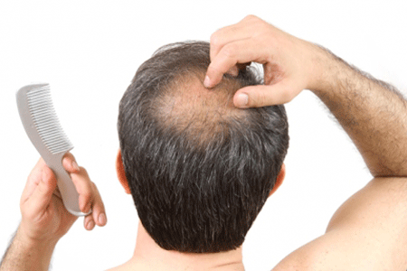 Có rất nhiều nguyên nhân rụng tóc ở nam giới