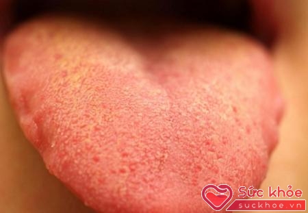 Cần nhận biết sớm các triệu chứng của bệnh sùi mào gà ở lưỡi