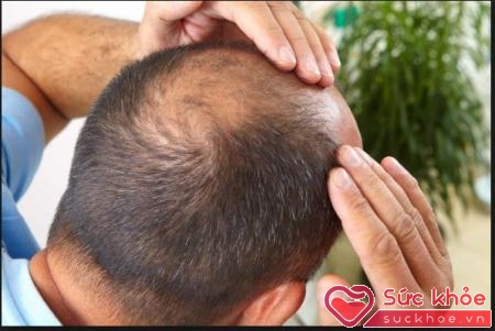 Có nhiều cách điều trị rụng tóc ở nam giới