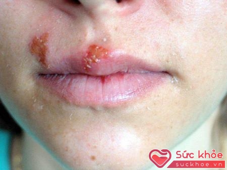 Cần cảnh giác trước những biểu hiện của bệnh giang mai ở miệng