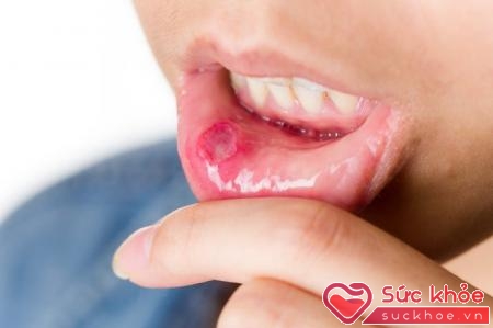 Các nốt loét xuất hiện là triệu chứng giang mai ở miệng