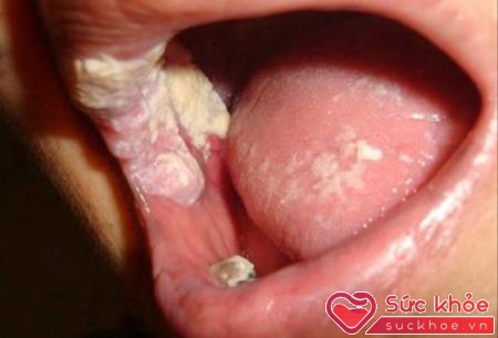Triệu chứng bệnh sùi mào gà ở miệng rất dễ nhầm lẫn với bệnh về răng miệng