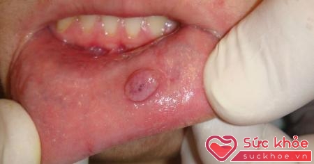 Triệu chứng bệnh giang mai ở miệng dễ nhầm lẫn với các bệnh về răng miệng