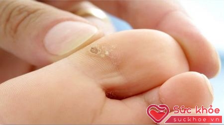 Mụn cóc là những u nhỏ tăng sản lành tính ở lớp thượng bì của da