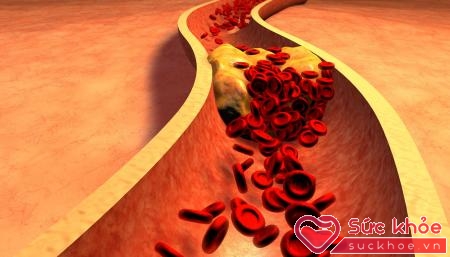 hàm lượng cholesterol trong máu cao dễ bị đau gân hoặc cấu trúc gân thay đổi.
