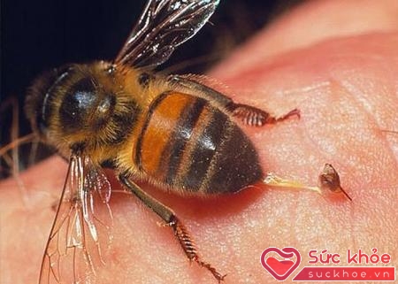 Ong đốt cần sơ cứu kẻo mang bệnh vào người