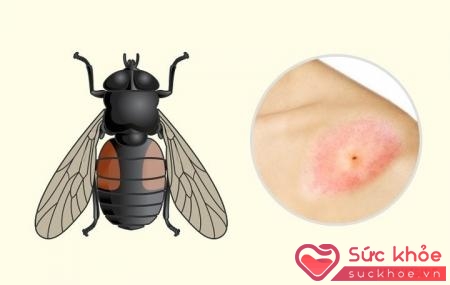 một số côn trùng có nọc độc nguy hiểm như ong, kiến... sẽ gây sốc phản vệ hoặc suy thận, suy gan cấp cho người bị cắn