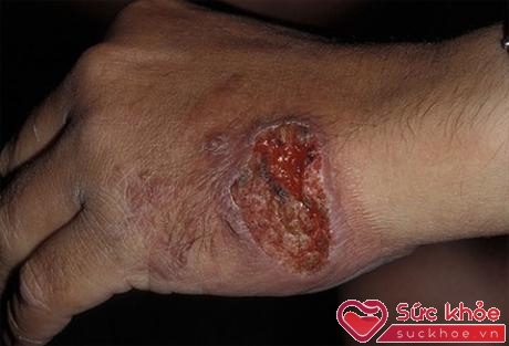 Con bọ chét và trứng của nó được ép từ da ở bàn chân một số người bị nhiễm 