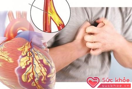 tắc nghẽn động mạch vành thường xảy ra ở người cao tuổi