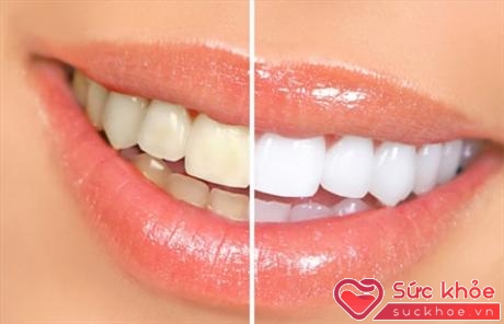 Các loại kem tẩy trắng răng không cần đơn chỉ hiệu quả nếu răng của bạn đủ sạch