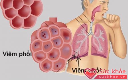 Cần phát hiện và điều trị kịp thời bệnh viêm phổi