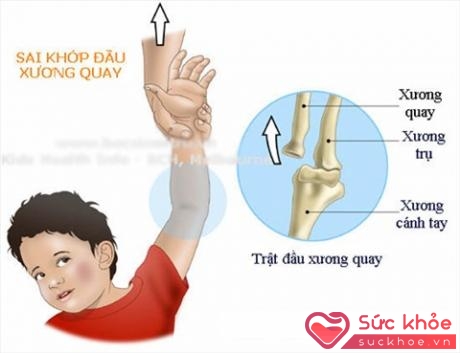 Sai khớp đầu xương quay xảy ra khi xương quay của cánh tay phía dưới khuỷu tay bị trật ra khỏi khớp xương cánh tay.