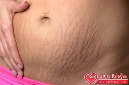 Bào thai càng lớn, vết rạn da ở bụng dưới, đùi… càng rõ hơn.