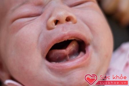 Dính lưỡi có thể gặp ở mọi lứa tuổi: trẻ sơ sinh, trẻ em, thanh thiếu niên hoặc người lớn