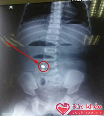 Hình ảnh chụp X-quang cho thấy có hình ảnh của dị vật trong bụng của trẻ.