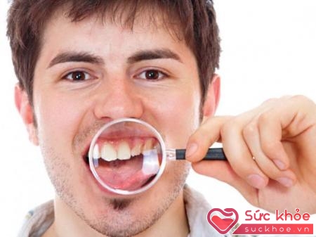 Để hạn chế cao răng cần làm vệ sinh răng miệng kỹ và thường xuyên chải răng 2 lần/ngày