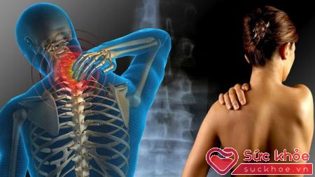 hội chứng đau cơ xơ hoá (HCCXH), là một tình trạng đau mạn tính trong cơ, dây chằng, gân và các tổ chức phần mềm của cơ thể.