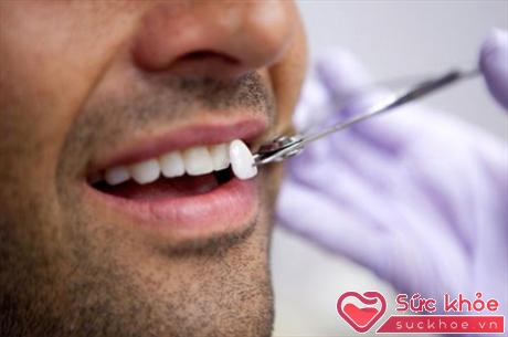 Sử dụng miếng dán sứ giúp răng không đổi màu theo thời gian