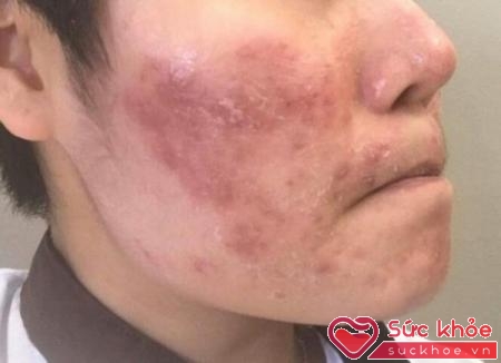 Bệnh chàm khô – eczema là một bệnh viêm da dị ứng, đây là tình trạng vùng da trên cơ thể bị thiếu độ ẩm, khô quá mức dẫn đến bong tróc, nứt nẻ và dẫn đến chảy máu.