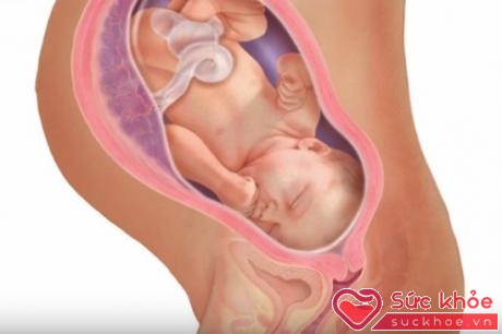 Lượng khí lớn xuất hiện trong quá trình tử thi phân hủy, dồn vào tử cung người mẹ khiến thai nhi bị đẩy ra ngoài qua âm đạo
