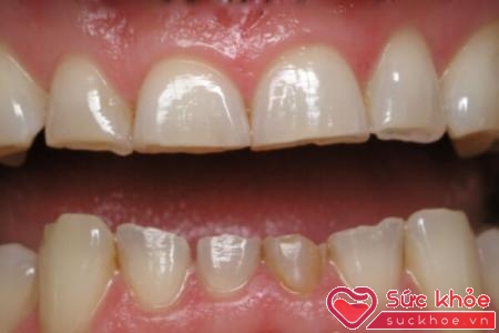 Các tổn thương mòn răng được chia thành 4 nhóm: mòn răng sinh lý, mòn răng bệnh lý, mòn hóa học và tiêu cổ răng.