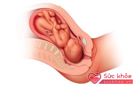 Trong quá trình tử cung co thắt, chúng sẽ tạo rất nhiều áp lực lên em bé.