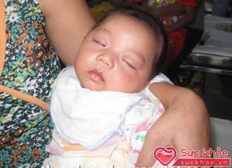 Một em bé bị nhiễm độc chì (nguồn: báo Gia đình và trẻ em)