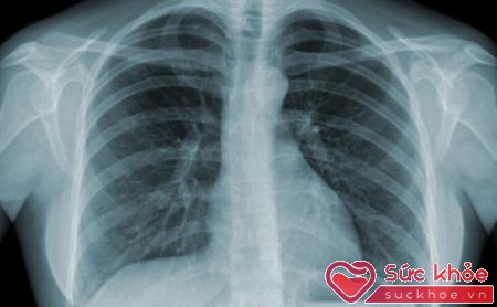 Hình ảnh phổi của bệnh nhân lao phổi trên phim chụp Xquang.