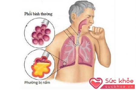 Điều trị nấm phổi do Candida chủ yếu dùng thuốc amphotericine B