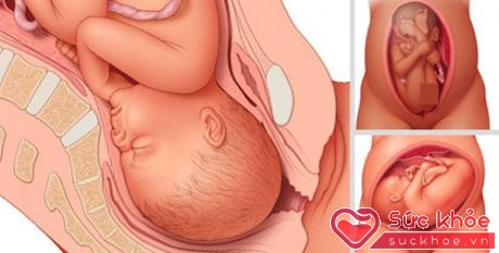 Vị trí nằm thuận lợi nhất để sinh thường là đầu quay xuống dưới, mặt úp vào bên trong bụng mẹ. 