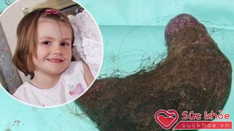 Bé gái Millie Wallis, 5 tuổi mắc chứng nghiện ăn tóc. Các bác sĩ đã phải phẫu thuật cho bé để lấy ra một búi tóc lớn