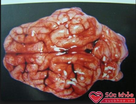 Xuất huyết não là một nguyên nhân gây tử vong bất thường.