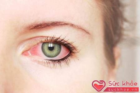Nếu mắt thường xuyên bị đỏ, bạn nên tới gặp bác sĩ