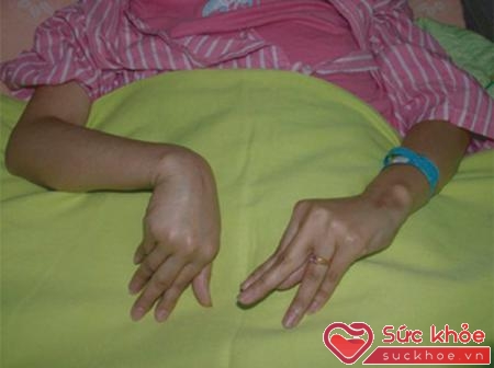 Co rút bàn tay (dấu hiệu Trousseau/bàn tay đỡ đẻ) trong hạ canxi máu.