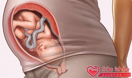 Ngôi thai là tư thế của em bé so với cổ tử cung người mẹ
