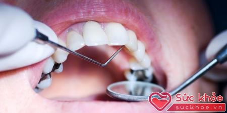 Lấy cao răng sẽ giúp duy trì hàm răng khỏe mạnh.