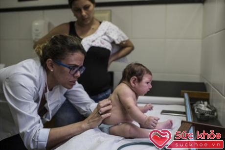 Vi-rút Zika được xem là tác nhân gây ra dị tật đầu nhỏ ở trẻ em