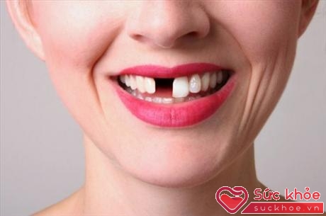 Nguy cơ sức khỏe khi bị sứt răng do ngã