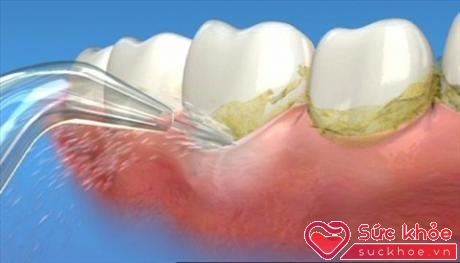 Cao răng là loại chất lắng cặn cứng của muối vô cơ gồm canxi carbonat và phosphate