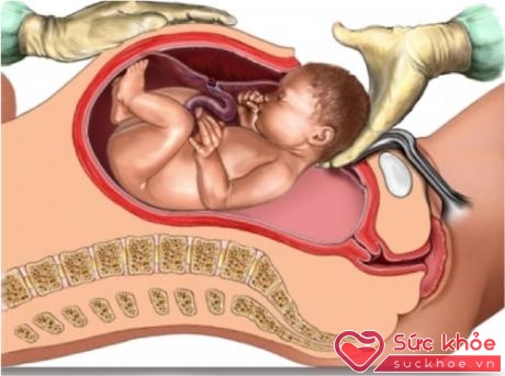 Sinh mổ là một phẫu thuật ổ bụng lớn, vì vậy nó có nhiều nguy cơ hơn sinh thường.