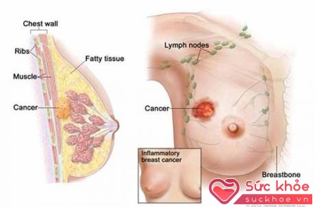 Không phải tất cả u vú đều là ung thư vú