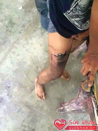 Một chân của nam thanh niên Thái Lan bị thương nặng do chiếc điện thoại phát nổ trong túi quần