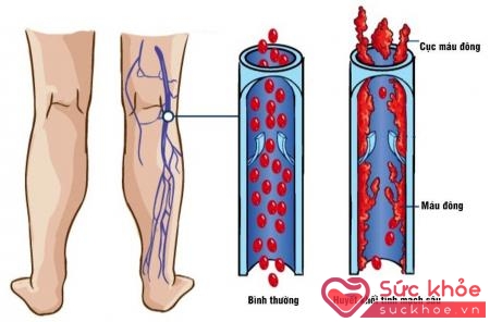 Bệnh huyết khối tĩnh mạch sâu là nguyên nhân khiến chân bạn sưng phù