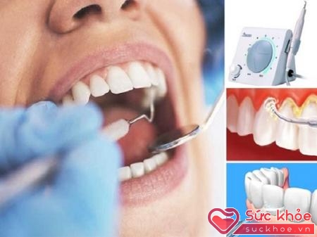 Để có hàm răng trắng đẹp, cần lấy cao răng định kỳ 6 tháng 1 lần.