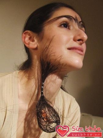 Chứng rậm lông ở phụ nữ là sự mọc lông thái quá do ảnh hưởng của nội tiết tố androgen