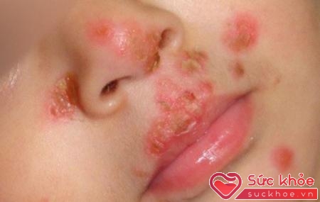 Chốc lây là một bệnh viêm da nhiễm khuẩn thường gặp ở trẻ em từ 2-6 tuổi