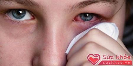 Đau mắt đỏ còn gọi là viêm kết mạc, nguyên nhân gây bệnh do virut